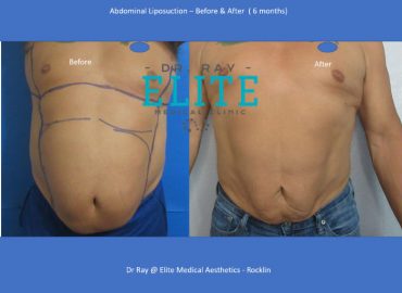Dr Ray – Liposuction Expert in Roseville